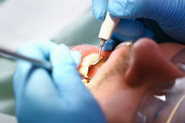 Best Emergency Tooth Extraction in Golden Valley, MN